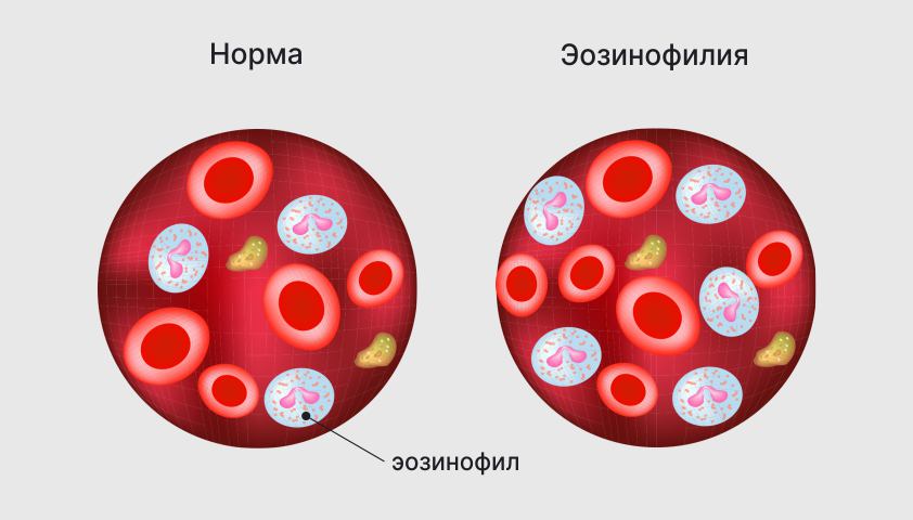 Эозинофилы повышены у взрослого в крови